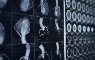 Ct Heart Scan Images