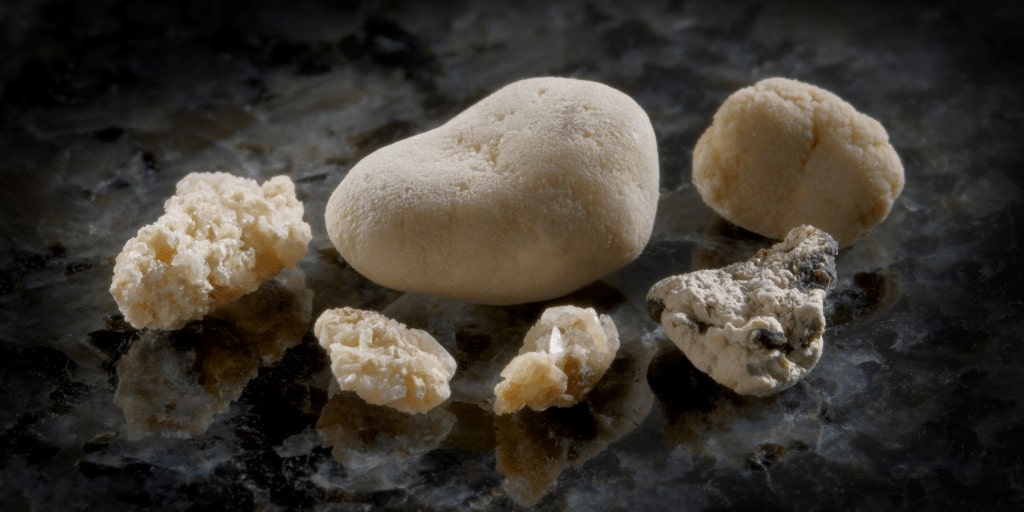 Kidney Stones