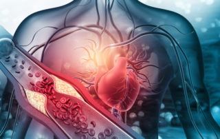 Human heart with blocked arteries illustration