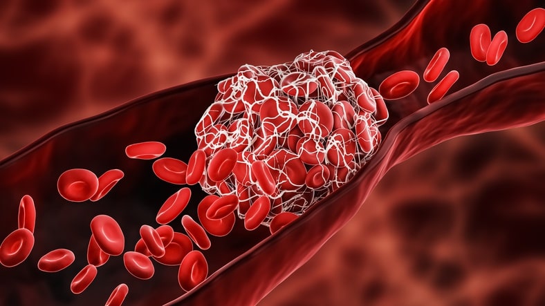 Blood Clot or thrombus blocking the red blood cells stream within an artery or a vein 3D rendering illustration. Thrombosis, cardiovascular system, medicine, biology, health, anatomy, pathology concepts.