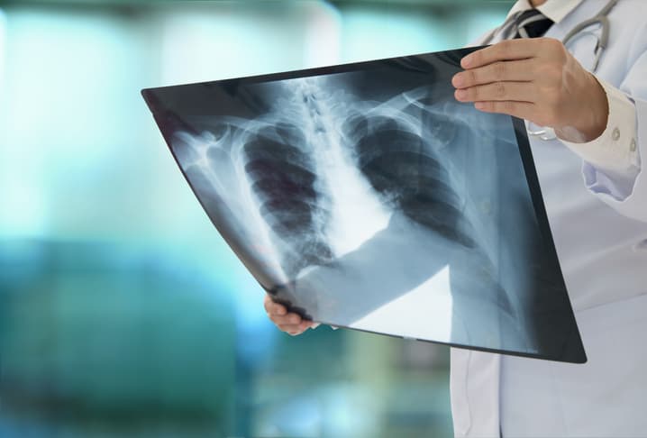 doctor holding x-ray of chest and lungs