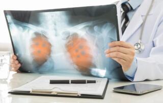 A doctor holds a chest X-ray that shows lung cancer.