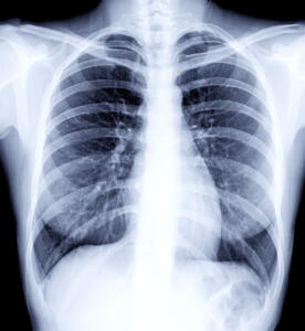 x-ray scan of lungs and chest 