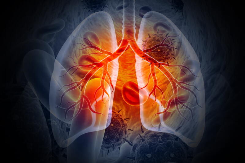 A medical 3D illustration showing lung cancer.