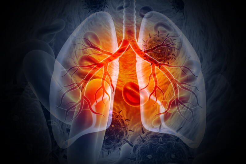 A Medical 3D Illustration Showing Lung Cancer.