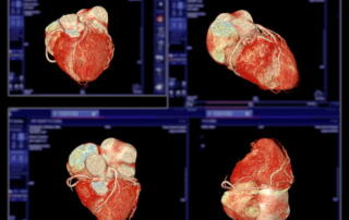 A Cta Coronary Artery 3D Rendering Image.