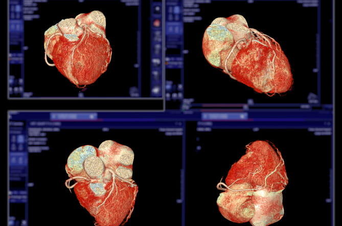 A Cta Coronary Artery 3D Rendering Image.