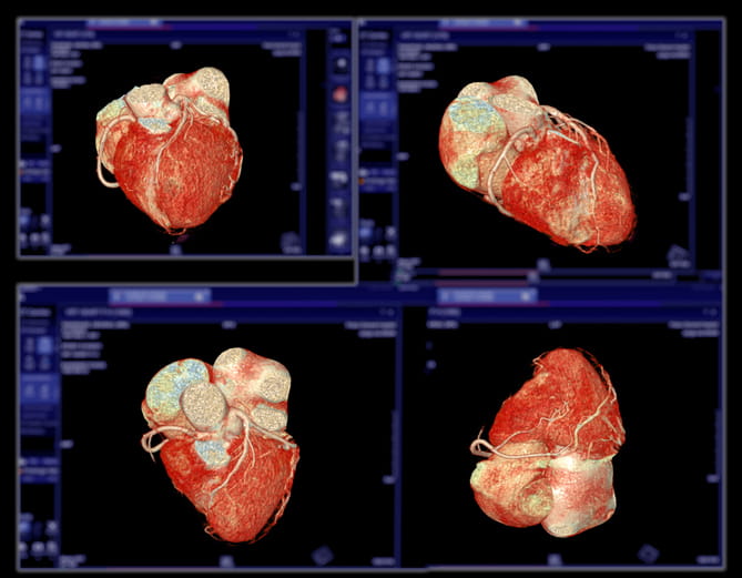 A Cta Coronary Artery 3D Rendering Image. 