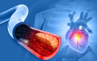 A Medical Illustration Showing A Cross-Section Of A Clogged Artery With Plaque Buildup On The Left, And A Corresponding Image Of A Human Heart With A Glowing Red Spot On The Right To Signify A Heart Attack.