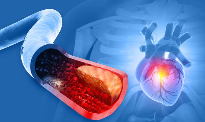 A Medical Illustration Showing A Cross-Section Of A Clogged Artery With Plaque Buildup On The Left, And A Corresponding Image Of A Human Heart With A Glowing Red Spot On The Right To Signify A Heart Attack.