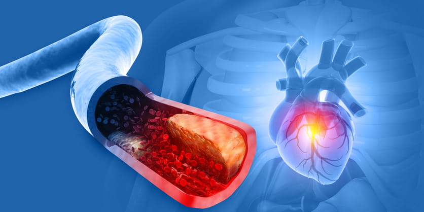 A Medical Illustration Showing A Cross-Section Of A Clogged Artery With Plaque Buildup On The Left, And A Corresponding Image Of A Human Heart With A Glowing Red Spot On The Right To Signify A Heart Attack.
