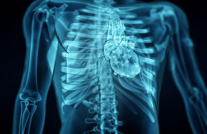 A 3D Medical Illustration Showing A Blue, X-Ray Style View Of The Human Torso. The Image Details The Rib Cage, Spine, And The Heart Positioned Within The Chest Cavity.