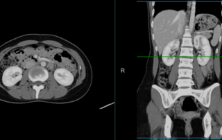 Can A Ct Scan Detect Cancer?