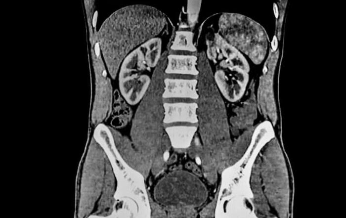 Pdc Home 1 An Abdominal Ct Scan.