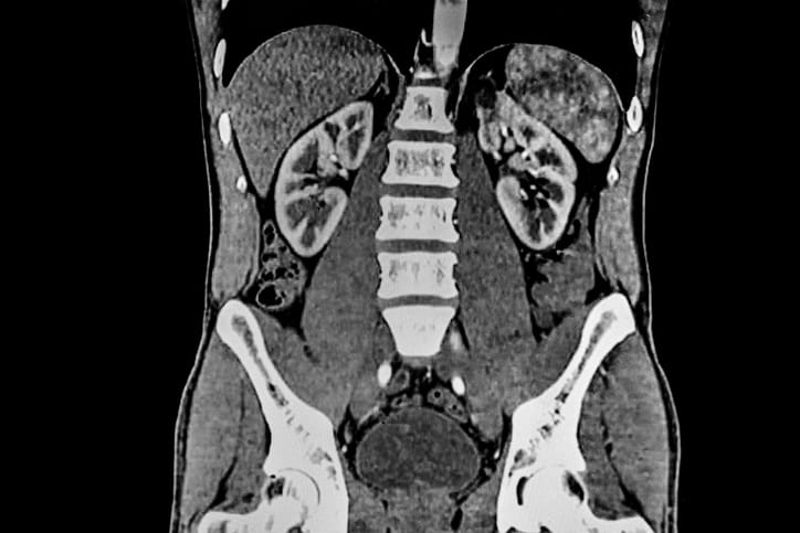 An Abdominal Ct Scan.